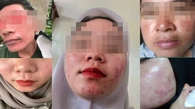 Wajah para korban-korban kosmetik ilegal yang dikirim oleh narasumber media ini