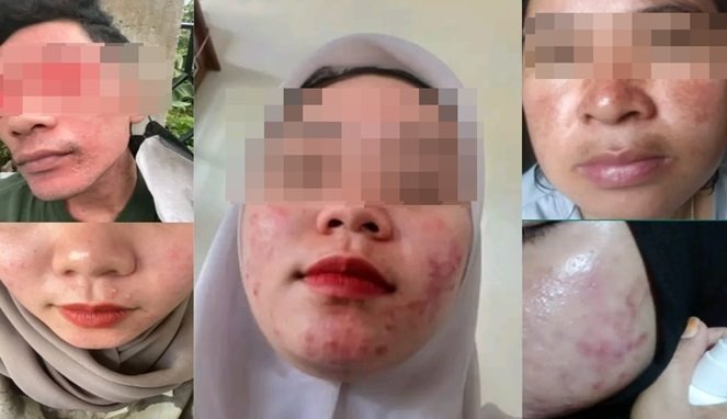Wajah para korban-korban kosmetik ilegal yang dikirim oleh narasumber media ini